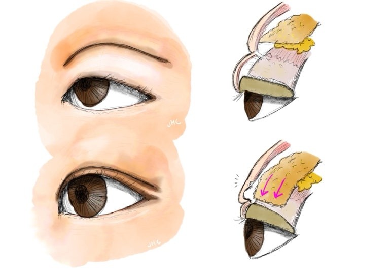 라인낮추기 재수술 일러스트