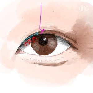 eye surgery 3